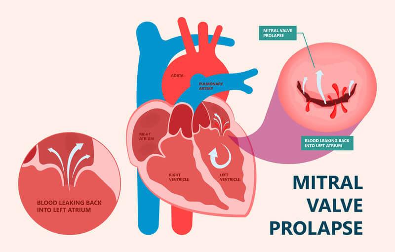 Mitral Valve Diseases - Sydnor Cardiovascular Center